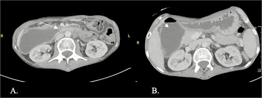 Axial contrast-enhanced computed tomography (CT) showing a stricture with thickening in the third and fourth parts of the duodenum (arrow) and proximal duodenal and gastric dilatation.