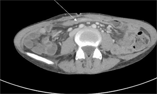 CT scan demonstrating thickening and abnormal enhancement of the neoterminal ileum (arrow), consistent with active CD.