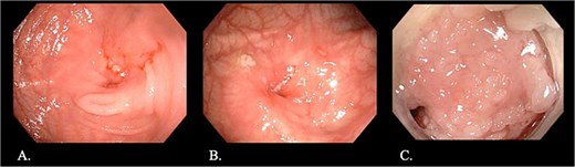 Endoscopic images: (A, B) Stricture at the ileocolic anastomosis with severely inflamed mucosa (arrows). (C) Non-traversable duodenal stricture observed during push enteroscopy.