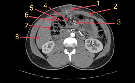 Axial CT image of the abdomen showing the inflammatory myofibroblastic tumor (1) in the supraumbilical anterior abdominal wall. The mass is closely associated with the rectus sheath (2), a presumed lymph node (3), and the greater omentum (4), which appears inseparable from the tumor. Adjacent bowel loops including the transverse colon (5), hepatic flexure (6), and ascending colon (7) are noted in close proximity. The liver is also partially visible (8) in the field.