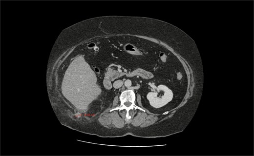 CT axial section showing a pathologically thickened appendix of 12 mm diameter (red measurement) projecting through a right posterolateral abdominal wall defect. There is also notable inflammatory fat stranding, with no evidence of perforation.