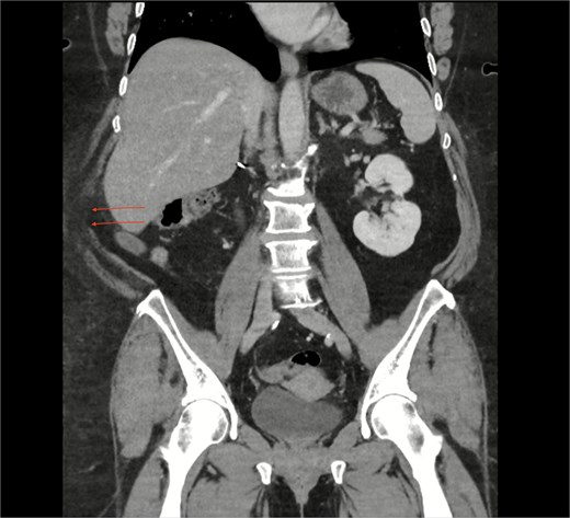CT coronal section highlighting notable right posterolateral abdominal wall defect (arrows).