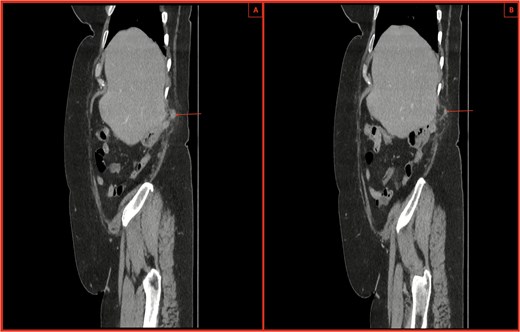 (A, B) CT sagittal sections with notable posterior abdominal wall hernial defect and appendix within hernia highlighted by arrows. There is also notable inflammatory fat stranding, with no evidence of perforation.