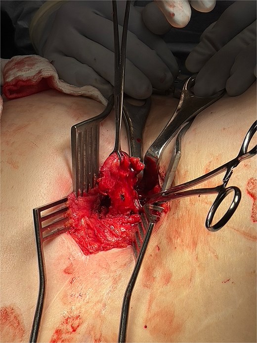 Intraoperative image showing entry into the posterior abdominal wall hernia using the same right nephrectomy scar. The peritoneum is opened and appendix is isolated.