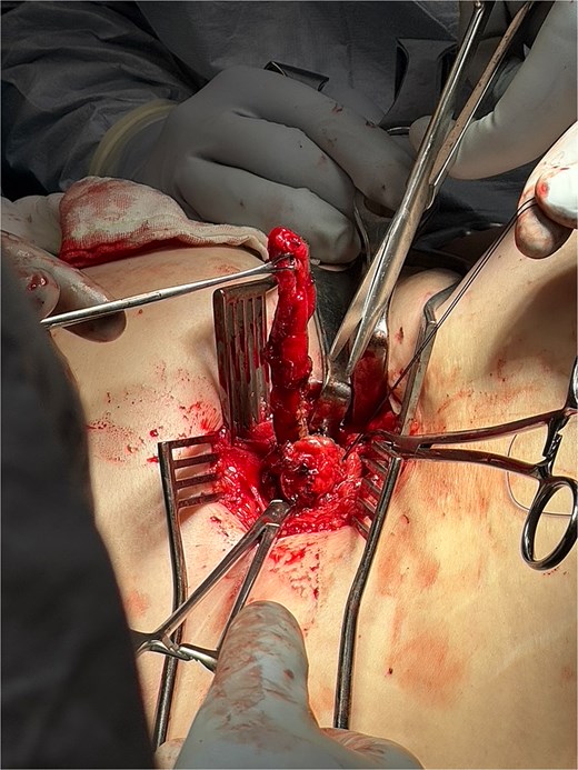 Intraoperative image showing isolated appendix with base being tied off with 0-Vicryl.