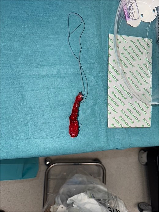Intraoperative image showing excised appendix with no signs of perforation.