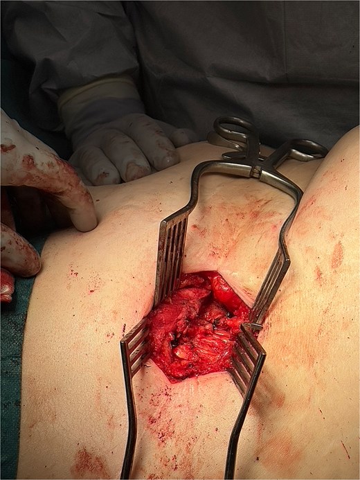 Intraoperative image showing external oblique fascial plane closed with 0-PDS, prior to insertion of Phasix biological mesh.