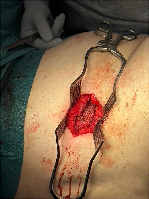 Intraoperative image showing Phasix biological mesh (in view) placed onlay over repaired hernial defect.