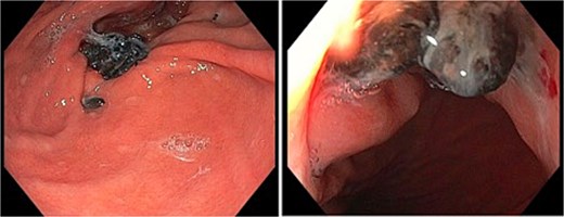Gastroscopy images of gastric cardia with visible sutures and mesh with associated adjacent mucosal erosion.