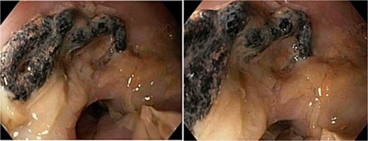Gastroscopy images of lower third of oesophagus showing multiple linear slough partially detached in sheets from the underlying mucosa, and a 2 cm piece of eroded mesh.