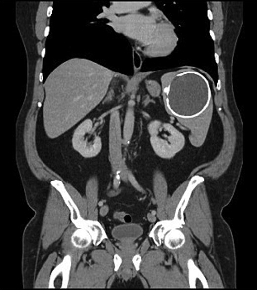 Coronal portal venous phase CT scan of the abdomen and pelvis demonstrating the calcified splenic lesion.