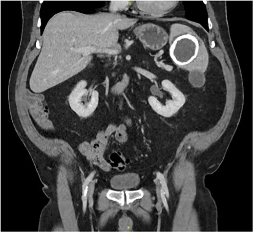 Coronal portal venous phase CT scan of the abdomen and pelvis demonstrating the subcapsular leak.