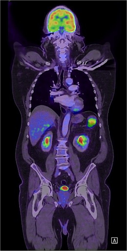 Coronal FDG PET scan of the head, neck, chest, and abdomen demonstrating a PET-avid LUQ lesion.