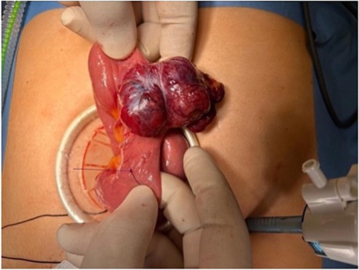 Laparoscopic-assisted delivery of a lobulated jejunal mass arising from the antimesenteric border, consistent with a gastrointestinal stromal tumour.