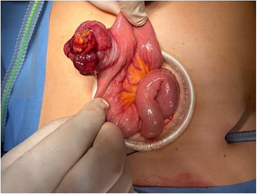 Exposure of the jejunal segment through a mini-laparotomy, demonstrating the exophytic tumour prior to segmental resection.