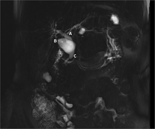 MRCP showing the common hepatic duct (A), cystic duct dilatation of 23 mm (B), and common bile duct of 14 mm (C).