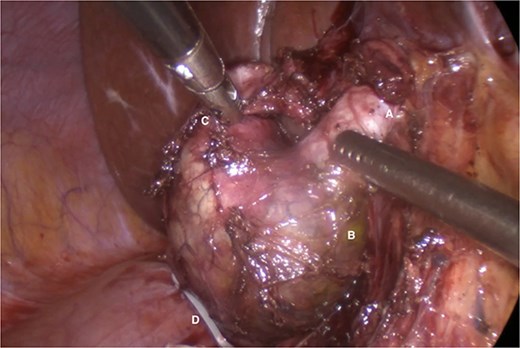 Common hepatic duct (A), fusiform dilatation of the common bile duct (B), cystic duct cyst (C), polymeric clip on the distal portion of the common bile duct once the distal dissection and resection at this level has been completed (D).