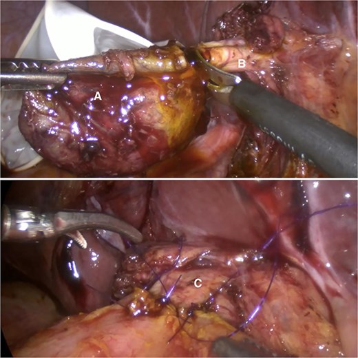 Complete excision of the cyst (A) at the level of the common hepatic duct (B); biliodigestive derivation conformation (C).