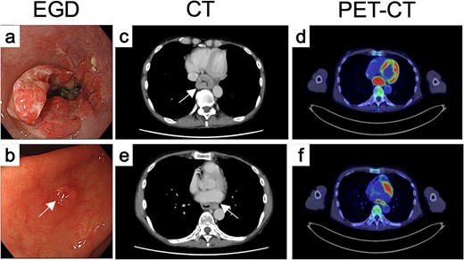 Endoscopic, CT, and FDG-PET findings before treatment. Endoscopic findings of (a) the primary tumor and (b) the gastric IM before treatment. (c) CT and (d) FDG-PET findings of primary tumor before treatment. (e) CT and (f) FDG-PET findings of metastatic LN.