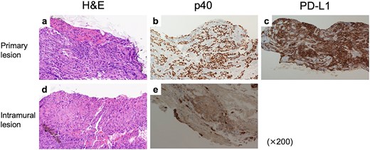 Pathological findings of tumors before treatment. (a) H&E stain, (b) p40 IHC, and (c) PD-L1 IHC findings of the primary tumor. CPS was estimated as 90. (d) H&E stain and (e) p40 IHC of the gastric IM.