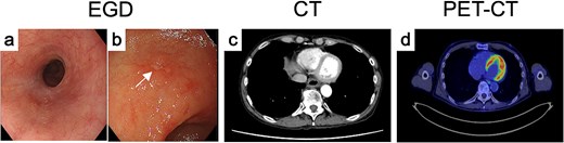 Endoscopic, CT, and FDG-PET findings after treatment. After induction chemoimmunotherapy, both (a) the primary tumor and the (b) IM markedly shrank. (c) CT and (d) FDG-PET findings of primary tumor after treatment.