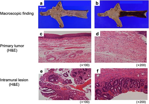 Pathological findings of resected specimens. Macroscopic findings of (a) non-stained and (b) iodine-stained resected specimen. H&E stain findings of the lesions (c, d) where the primary tumor was originally located, and (e, f) where the gastric IM was originally present.