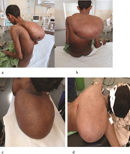 (a–d) Different views of the mass. And 1A MUAC was 15.7 cm.