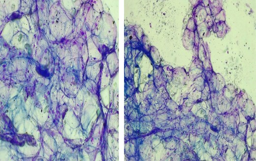 FNAC results showing showed large, round cells with clear cytoplasm.
