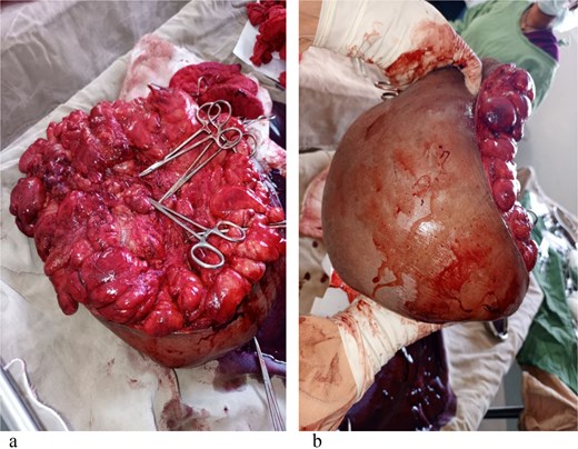 (a, b) The mass after excision (measures around 25 kg).