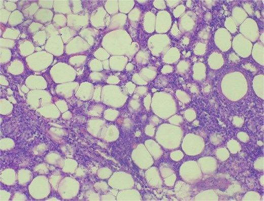 Histopathologic image showing benign adipose tissue tumor.