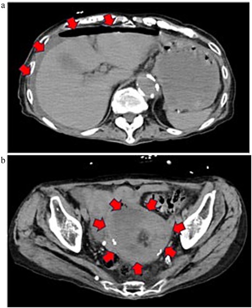Preoperative contrast-enhanced CT image (equilibrium phase). (a) Horizontal section. Extensive ascites extending to the liver surface and free gas in the abdominal cavity are noted. (b) Horizontal section. A low-attenuation area suggestive of a retained uterine abscess was identified within the uterus.