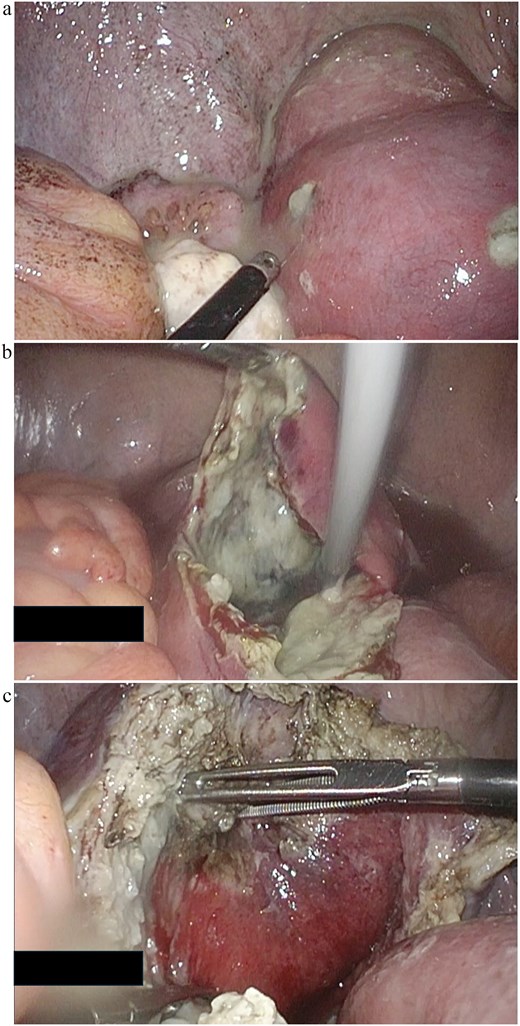 Laparoscopic surgical images of the case: (a) Two perforations in the uterine body, sites of purulent discharge. (b) Findings after incising the uterine muscle layer to connect the two perforation sites and draining the cavity. (c) Findings after partial resection of the uterine wall.