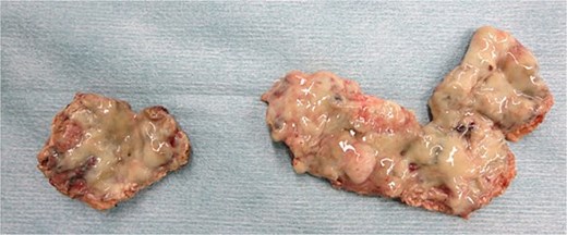 Resected uterine wall: An abscess adherent to the inner surface of the resected uterine wall.