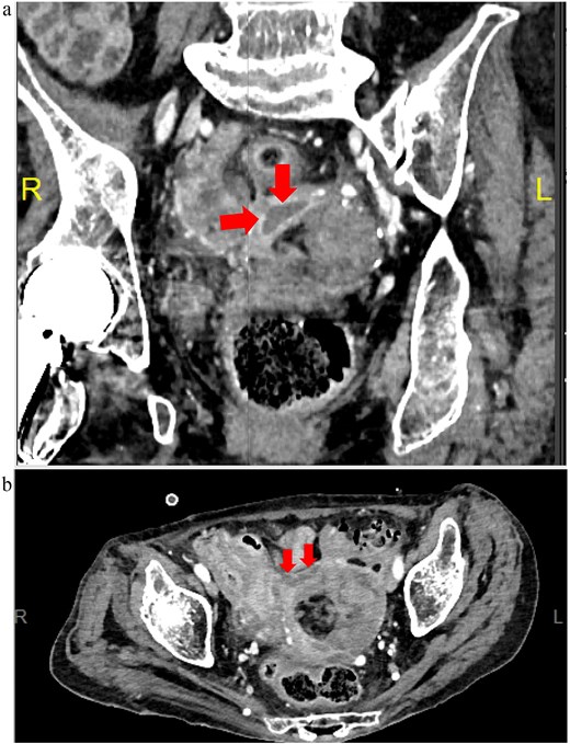 Postoperative Day 18 contrast-enhanced CT images (equilibrium phase). (a) Coronal view; (b) horizontal view.