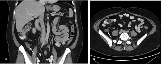 (A) Portal venous phase coronal slice of CT image with arrow pointing to dilated tip of the appendix. (B) Axial slice of same.