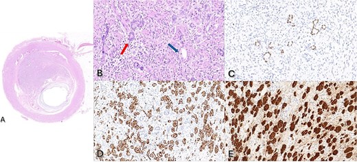 (A) Haematoxylin and eosin (H&E) stain of mid appendiceal lesion with 2x magnification. (B) H&E stain at 40x magnification with red arrow demonstrating goblet cell adenocarcinoma and blue arrow demonstrating neuroendocrine tumor. (C) Positive CDX2 stain consistent with goblet cell adenocarcinoma. (D) Positive CD56 immunohistochemistry and (E) Positive chromogranin immunohistochemistry consistent with neuroendocrine tumor.