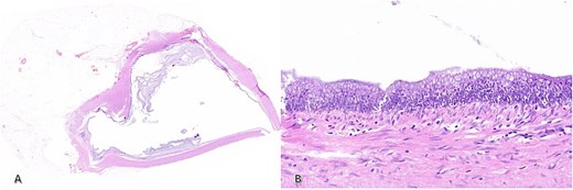 H&E staining of (A) distal appendix at 2x magnification demonstrating the dilated lumen and (B) 20x magnification slice showing dysplasia of the epithelium consistent with LAMN.