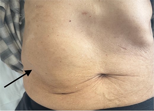 Clinical photograph of the abdomen demonstrating a localized swelling of the right hypochondrium (arrow), consistent with a parietal abdominal wall abscess.