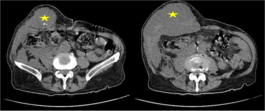 Contrast-enhanced CT scan of the abdominal wall showing a parietal abscess containing hyperdense foci consistent with retained gallstones (star).