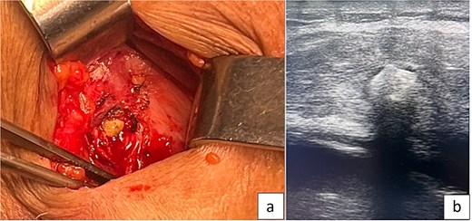 (A) Intraoperative image showing a parietal gallstone within the abdominal wall abscess cavity. (B) Intraoperative ultrasonography demonstrating a retained parietal gallstone.