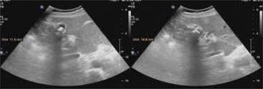 Preoperative ultrasonography demonstrated gallstones, with a normal-caliber common bile duct; the gallbladder was reported in a normal position and ectopic location was not specifically assessed.
