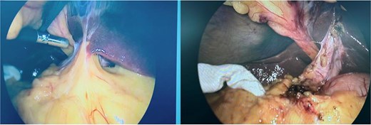 The greater omentum adherent to the inflamed gallbladder, shown before and after adhesiolysis.