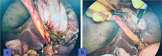 Intraoperatively, the gallbladder was found entirely to the left of the round ligament without situs inversus (a). The epigastric trocar was repositioned to the left of the falciform ligament to improve exposure and facilitate dissection (b).