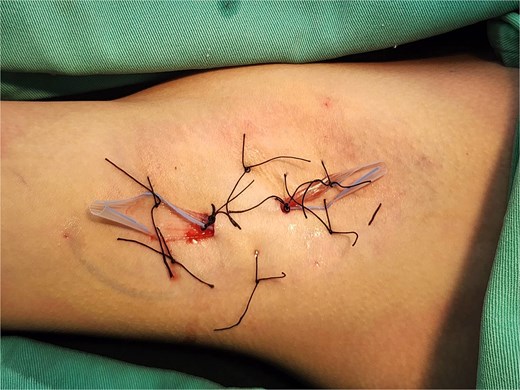Bilateral axillary drains (5-mm Penrose) secured with 3–0 silk sutures via anterior and posterior incisions, with quilting sutures (3–0 silk) obliterating dead space.