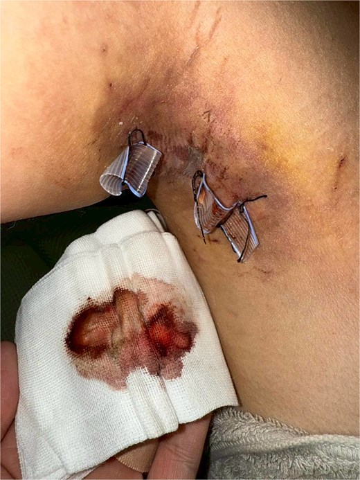 Daily postoperative photograph showing Penrose drains in situ with serosanguinous output on gauze, used for monitoring drainage amount and flap condition.