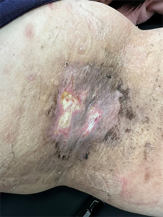 One case showing 1.5 × 1.0 cm and 0.5 × 0.5 cm superficial white dermal erosions on the left axilla 2 weeks after early drain removal (POD 3).