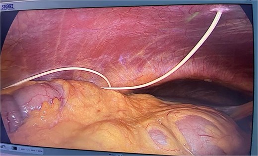 Picture demonstrating VP shunt in the peritoneal cavity.