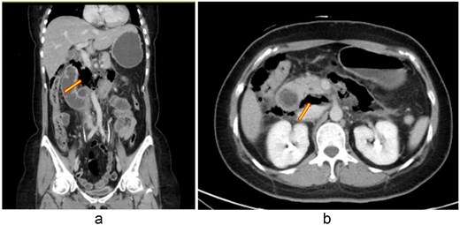 (a, b) Contrast-enhanced abdominal CT scan (26 August 2025). Imaging demonstrates retroperitoneal free air with suspicion of perforation in the retroperitoneal region.