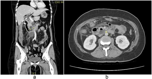 (a, b) Contrast-enhanced abdominal CT scan (coronal and axial views, 2 September 2025). Imaging demonstrates extraluminal air bubbles and a retroperitoneal abscess (arrow) adjacent to the third portion of the duodenum, consistent with duodenal perforation.
