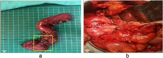 (a) The area of exposed mucosa represents the entire duodenal perforation. The yellow box highlights the perforation site. The apparent enlargement reflects ex vivo changes due to surgical dissection and traction. (b) Reconstruction following segmental duodenectomy. An end-to-side, hand-sewn, full-thickness duodenojejunostomy was performed using 4–0 monofilament absorbable sutures, followed by an additional outer layer of Lembert sutures.